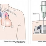 Gestione infermieristica dei sistemi totalmente impiantabili (PORT-A-CATH)