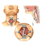 Nursing della Tracheostomia: un “MIX” tra conoscenze, capacità e competenze infermieristiche 6