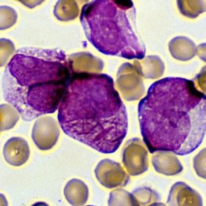 Leucemia acuta promielocitica: una rara forma dall’esordio improvviso