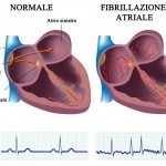 All’IRCCS Negrar, radiazioni per il tumore anche contro la fibrillazione atriale