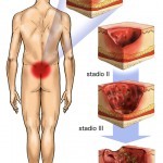 Lesioni da pressione: responsabilità infermieristica 1