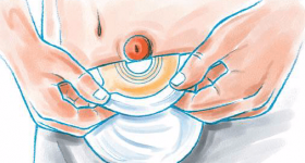 Gestione integrata del paziente stomizzato tra reparto di degenza e centro stomie: Creazione di un opuscolo di supporto nello "stomacare" applicato in urologia