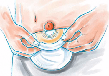 Gestione integrata del paziente stomizzato tra reparto di degenza e centro stomie: Creazione di un opuscolo di supporto nello "stomacare" applicato in urologia