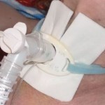 Tracheostomia e Cannule tracheostomiche: gestione infermieristica 13