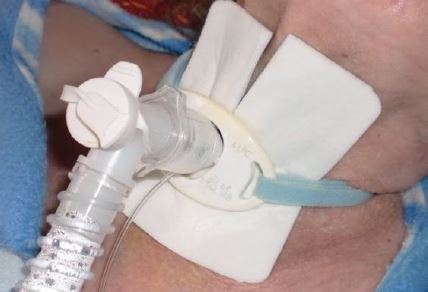 Ventilazione Del Tubo Tracheostomico Produttori E Fornitori Di Tubi Ventilazione Del Tubo Tracheostomico Produttori E Fornitori Di Tubi