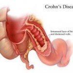 Malattia di Crohn e Colite Ulcerosa in aumento in Italia