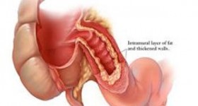 Malattia di Crohn e Colite Ulcerosa in aumento in Italia