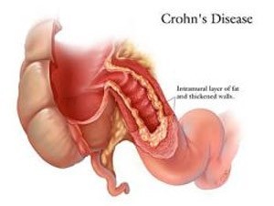 Malattia di Crohn e Colite Ulcerosa in aumento in Italia