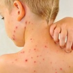 Scarlattina: sintomi, cause, terapia e prevenzione