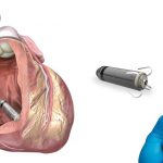 Pacemaker: storia ed evoluzione tecnologica