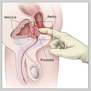 PSA (Antigene Prostatico Specifico) alto nel sangue: cos'è e come interpretare gli esami