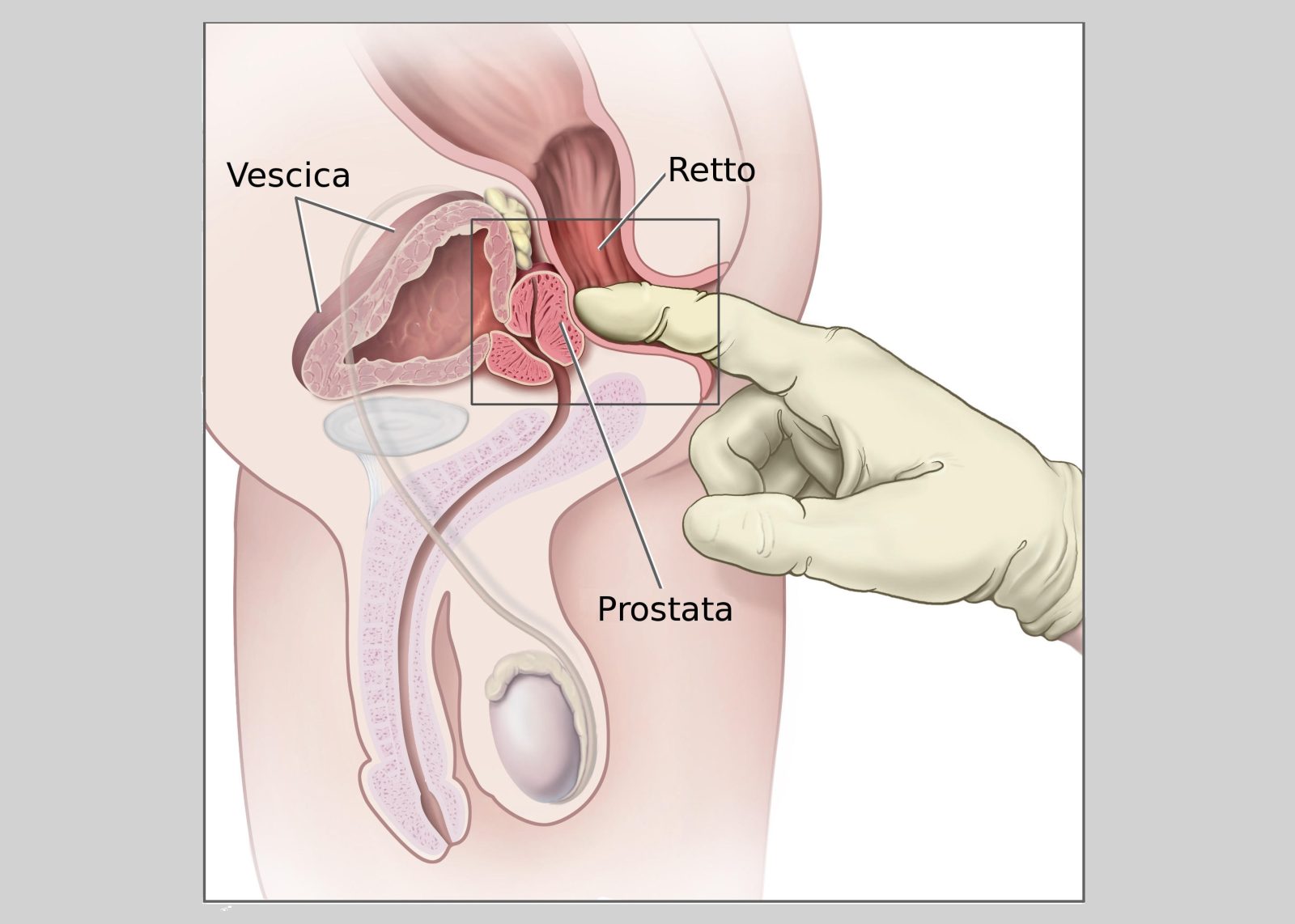 prostata marita si calcificata