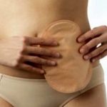 Confronto della qualità della vita nei pazienti portatori di ileostomia e colostomia: revisione della letteratura
