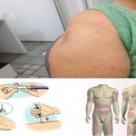 Rapporto tra lipodistrofia e tecnica iniettiva: raccomandazioni