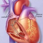 Un mini-robot naviga fino al cuore e ripara una valvola cardiaca al Boston Childrenʼs Hospital
