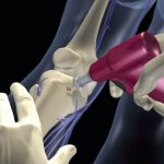 Accesso Intraosseo: indicazioni, controindicazioni, procedure e sedi d'inserzione