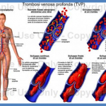 Trombosi Venosa Profonda: lo Score Di Wells