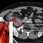 Score al triage per diagnosticare appendicite: criterio di Alvarado