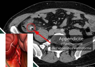 Score al triage per diagnosticare appendicite: criterio di Alvarado