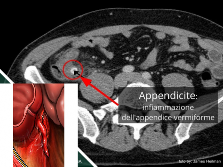 Score al triage per diagnosticare appendicite: criterio di Alvarado
