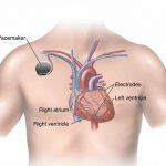 Il monitoraggio remoto dei dispositivi cardiaci impiantabili rivoluziona l’assistenza sanitaria 1
