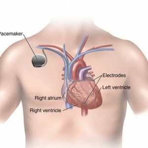 Il monitoraggio remoto dei dispositivi cardiaci impiantabili rivoluziona l’assistenza sanitaria 1