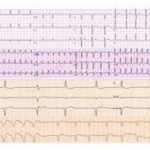 Cardiologia In Rima: la filastrocca dell'Ecg