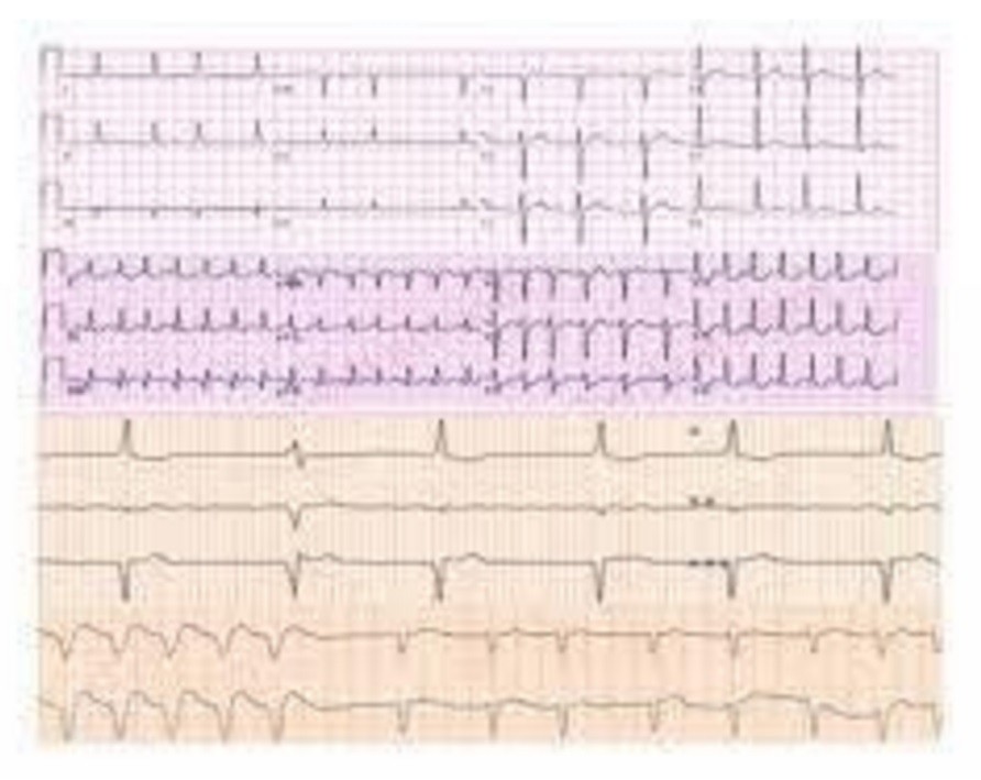 Cardiologia In Rima: la filastrocca dell'Ecg