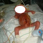 La presa in carico del neonato critico portatore di catetere venoso ombelicale, gestione e prevenzione delle complicanze