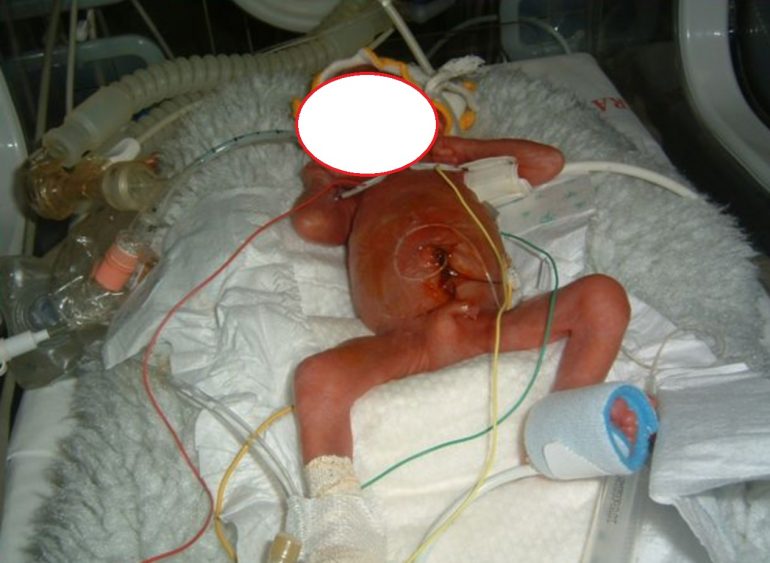 La presa in carico del neonato critico portatore di catetere venoso ombelicale, gestione e prevenzione delle complicanze