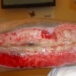 V di Vulnologia: Come valutare il rischio di sviluppare lesioni da pressione