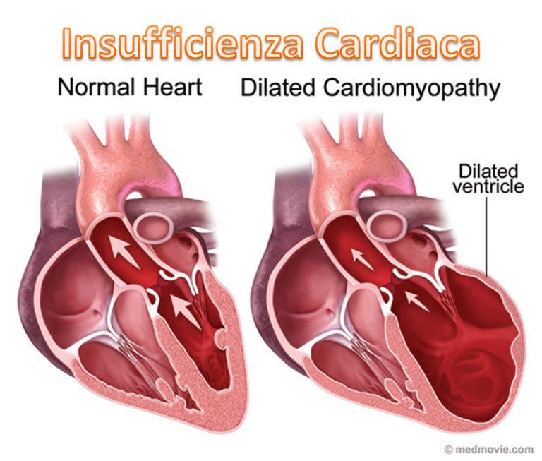 Entresto, Nuovo Farmaco Nel Trattamento Della Insufficienza Cardiaca ...