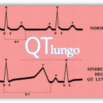 Tempo QT ed E.C.G., come riconoscerlo. Patologie correlate