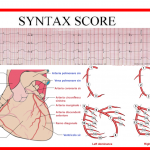 Syntax Score: indice di anatomia coronarica
