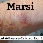 Cosa sono le MARSI e come prevenire i danni da rimozione dei cerotti
