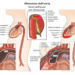 Diagnosi Dissezione Aortica con A.D.D. Score 3