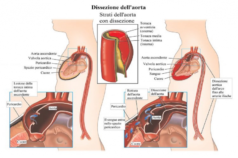 Diagnosi Dissezione Aortica con A.D.D. Score 3