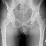 Diagnosi rapida e semplice di frattura di femore, la Manovra di Wood 3