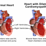 Nuovo marker di rischio aritmico per pazienti con cardiomiopatia ipertrofica
