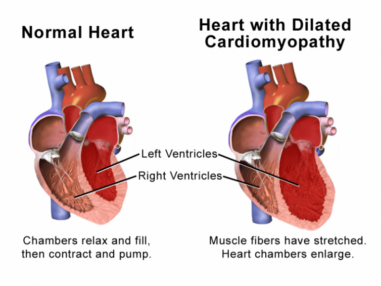 Nuovo marker di rischio aritmico per pazienti con cardiomiopatia ipertrofica