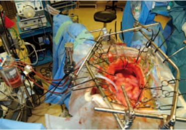 Primo intervento di cito-riduzione chirurgica associato a chemio-ipertermia intraperitoneale eseguito a Modena