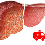 La valutazione della medicina d'urgenza e la gestione del paziente con cirrosi 2