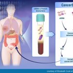 CancerSEEK: con un prelievo di sangue si potrà diagnosticare precocemente il Cancro?