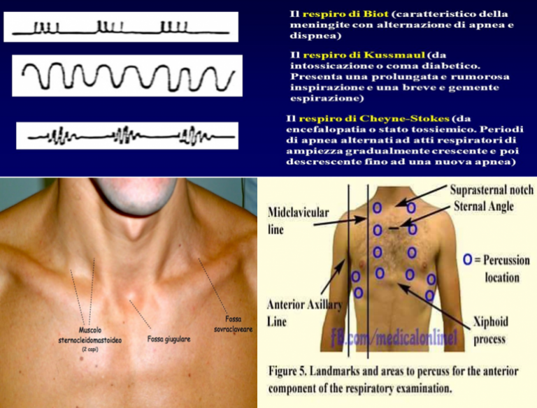 Disordini respiratori nello stato di incoscienza associati a trauma