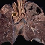 Nuovo test sulle urine per diagnosticare la Tbc