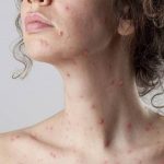 Morbillo, casi aumentati del 400% in Europa