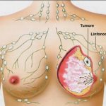 NeXT. Percorso diagnostico-terapeutico della paziente affetta da neoplasia mammaria