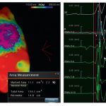 Sindrome di Brugada: descritta per la prima volta l'anomalia elettrica che colpisce il cuore 6