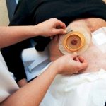 Stomaterapia, il gruppo Gesto presenta il Decalogo dell’assistenza di qualità