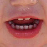 Tumori e terapia: come prevenire patologie orali in età evolutiva